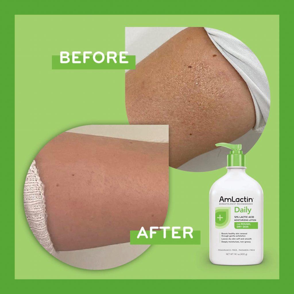 Amlactin Daily Moisturizing Body Lotion For Keratosis Pilaris Amlactin Moisturizing Body Exfoliator and Lotion with 12% Lactic Acid