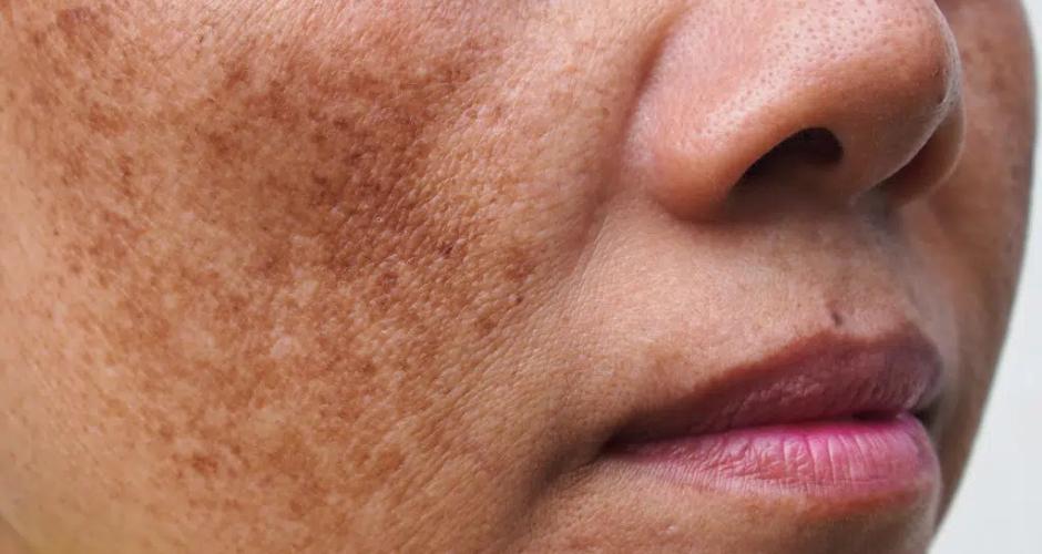 Woman with hyperpigmentation on skin Dreamskinhaven