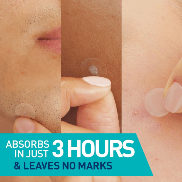 Close-up of CeraVe Blemish Barrier Patches on different skin tones, showing visible results after 3 hours of oil and pus absorption without leaving marks on the skin.