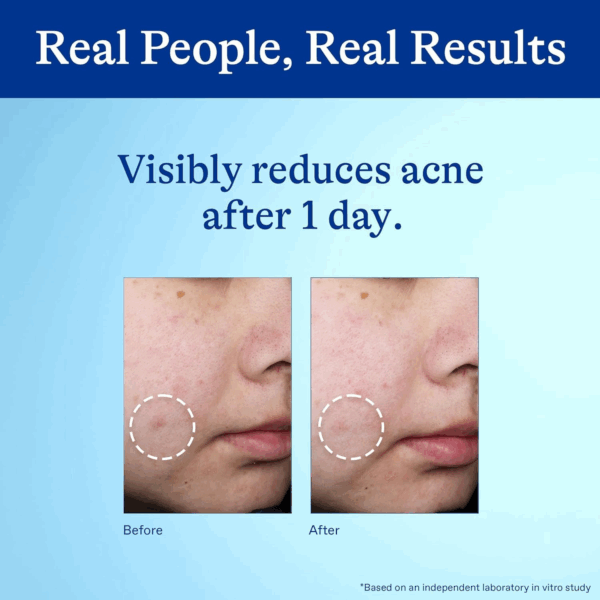 Before and after results of Differin 10% Benzoyl Peroxide Acne Spot Treatment showing visible reduction in acne after 1 day