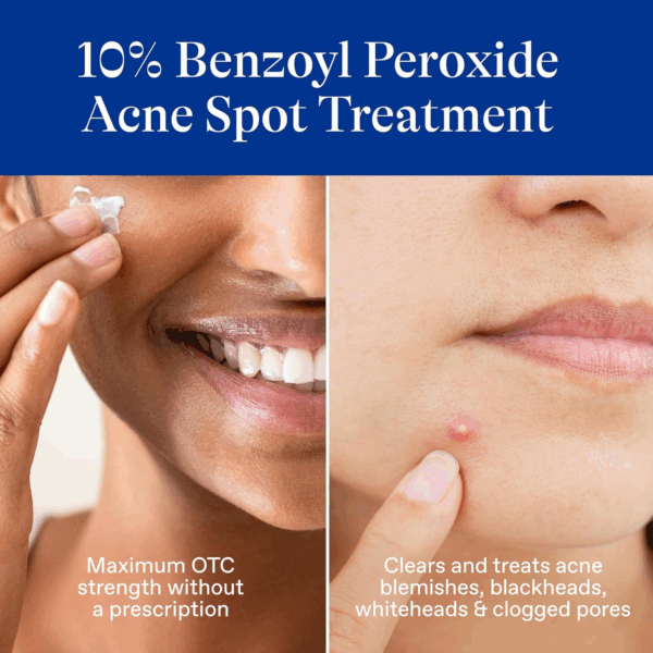 Close-up of woman applying Differin 10% Benzoyl Peroxide to active blemish and treating clogged pores