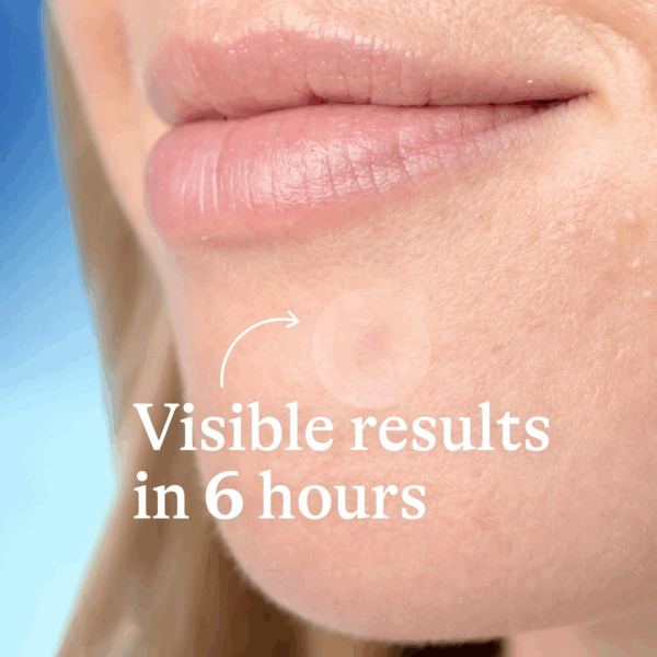Close-up of chin wearing a Differin Power Patch showing visible results after 6 hours
