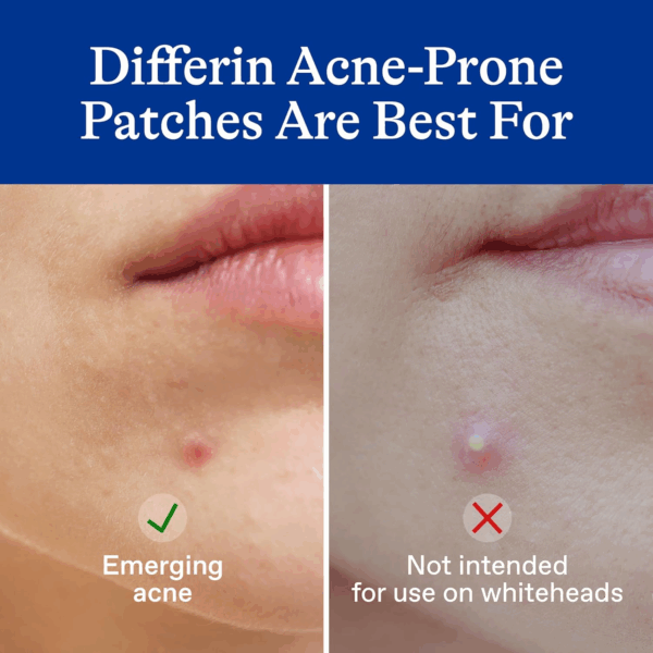 Side-by-side comparison showing Differin Power Patch is best for emerging acne, not whiteheads
