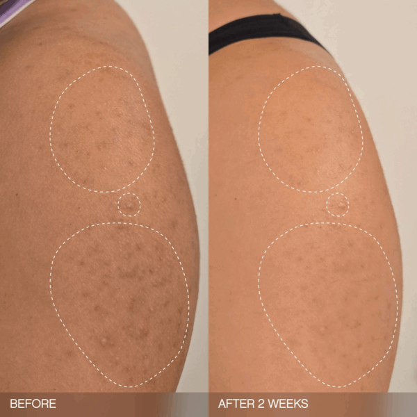 Arm texture before and after two weeks of use showing fewer bumps and smoother tone.