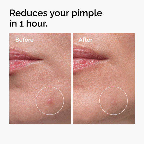 Before and after closeups showing a reduced pimple after one hour with circles highlighting the area.